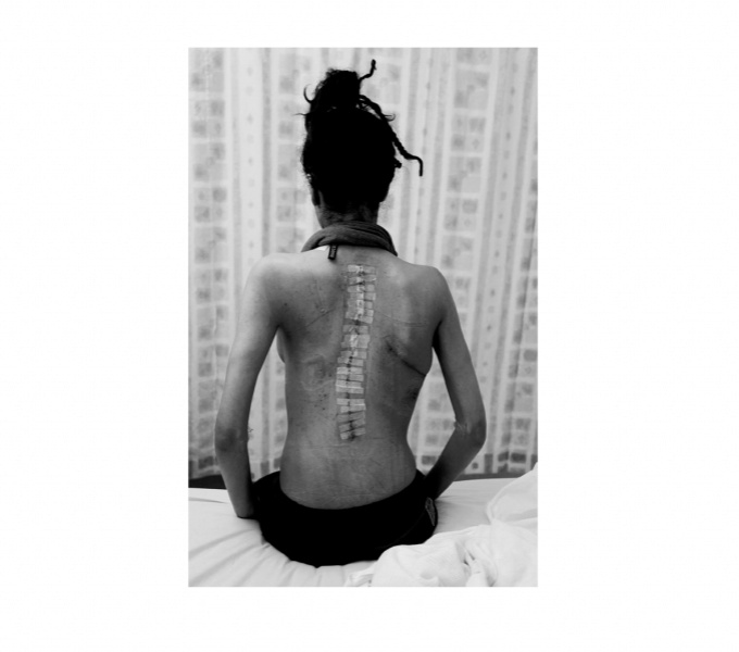 A black and white image of a black woman sat on a bed. They face away from the camera. Their dark hair is tied loosely above their head, their torso is naked. Along their spine are pieces of white medical tape, placed after a procedure.
